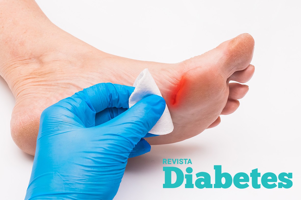 Causas y prevención del pie diabético