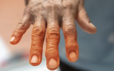 ¿Existe relación entre la diabetes y la artritis reumatoide?