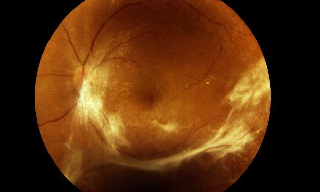 Conoce qué es el edema macular diabético y cómo prevenirlo